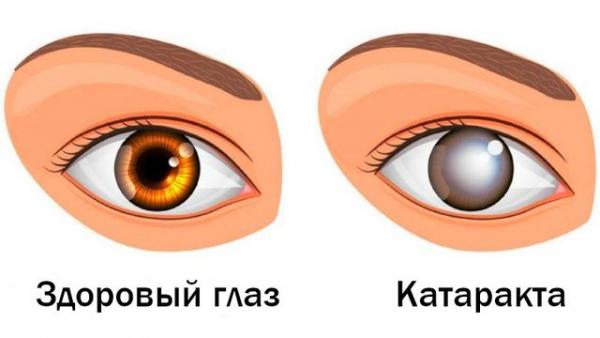 Бесшовное удаление катаракты проводится за 10-15 минут