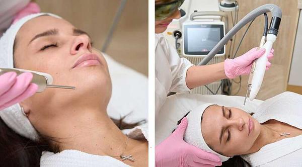 Лазерная шлифовка лица