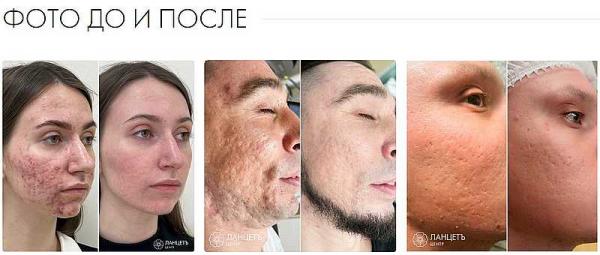 лазерная шлифовка кожи