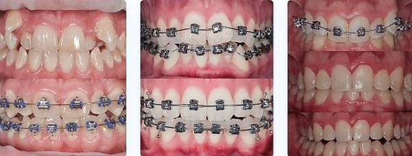 Установка брекетов