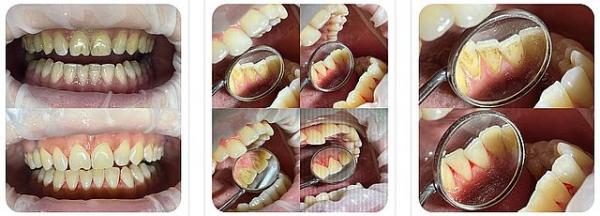 Профгигиена полости рта Профгигиена полости рта